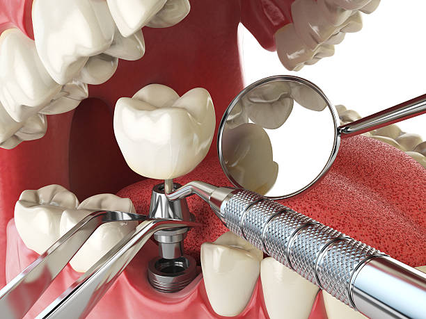 Best Emergency Root Canal Treatment in Pine Mountain Lake, CA